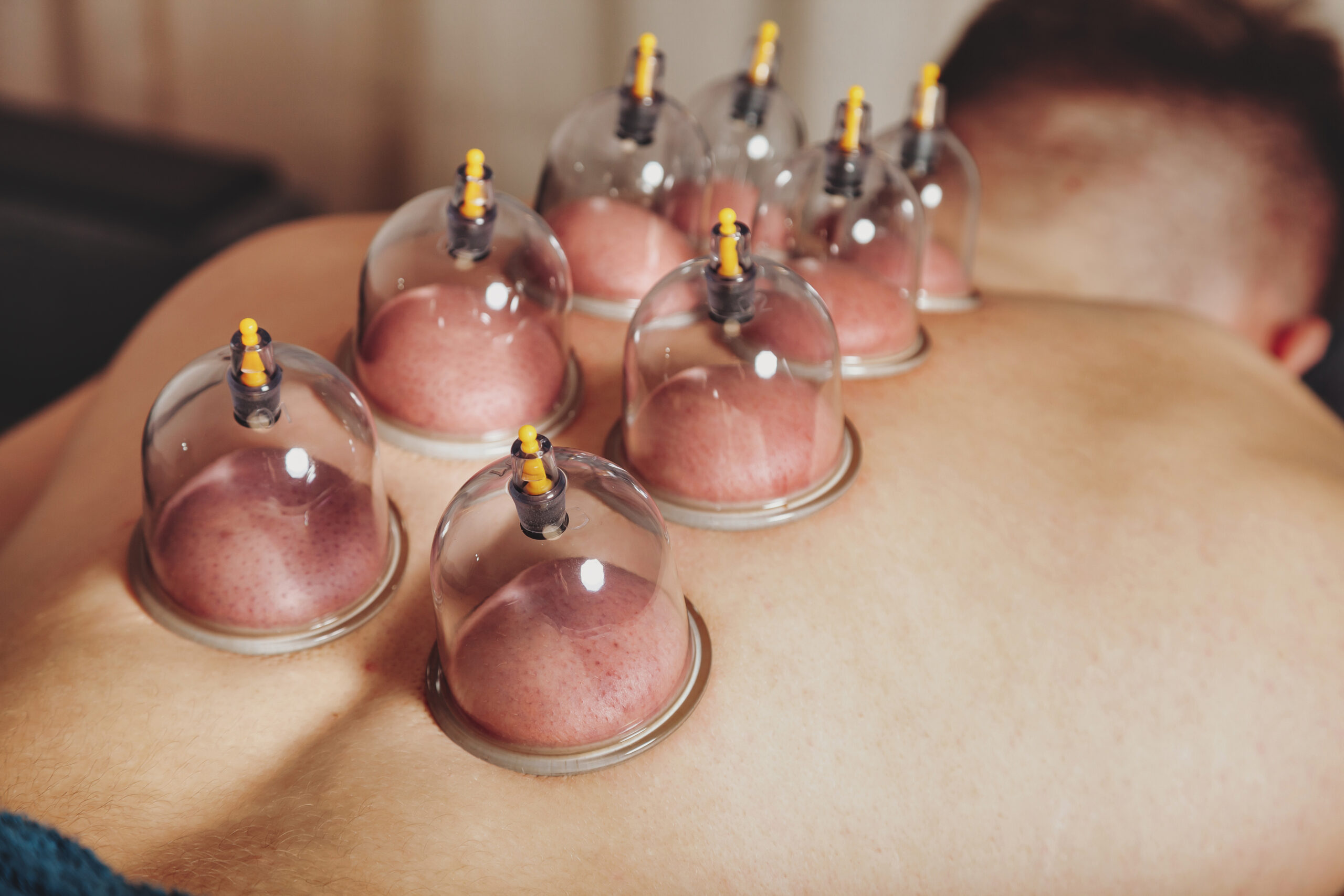 Close-up for multiple vacuum cups, medical cupping therapy on human body. Doctor with cups for patient, therapy. Wellness, health injury rehabilitation concept. Alternative medicine. Copy space