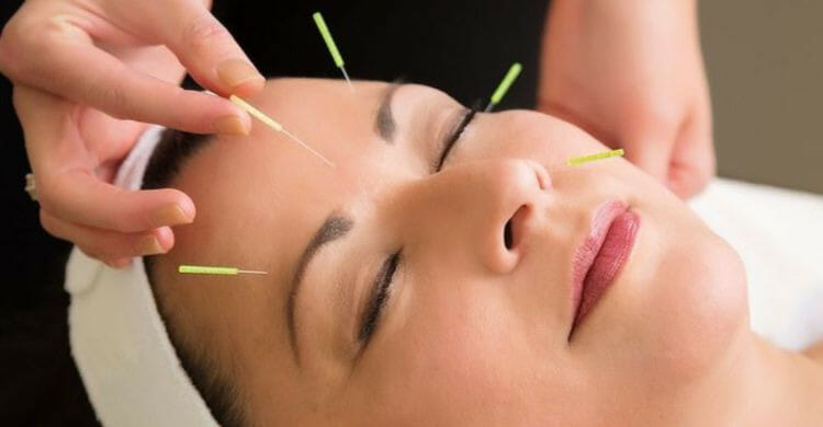 acupuntura-facial-lo-ultimo-para-eliminar-las-arrugas